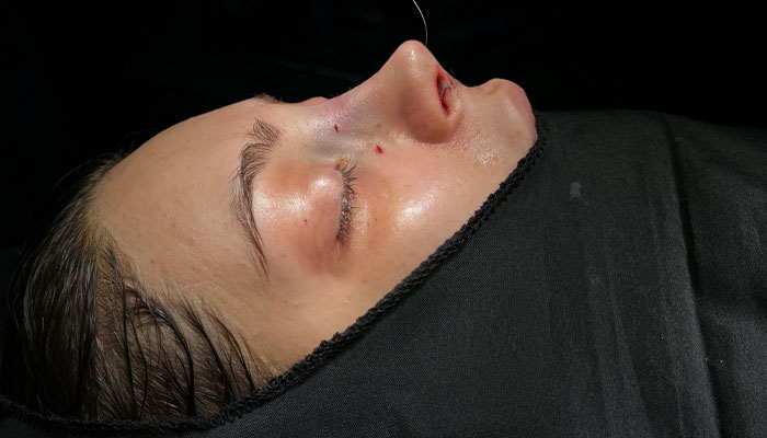 نمونه-کار-دکتر-لیلا-نوری-بعد-عمل