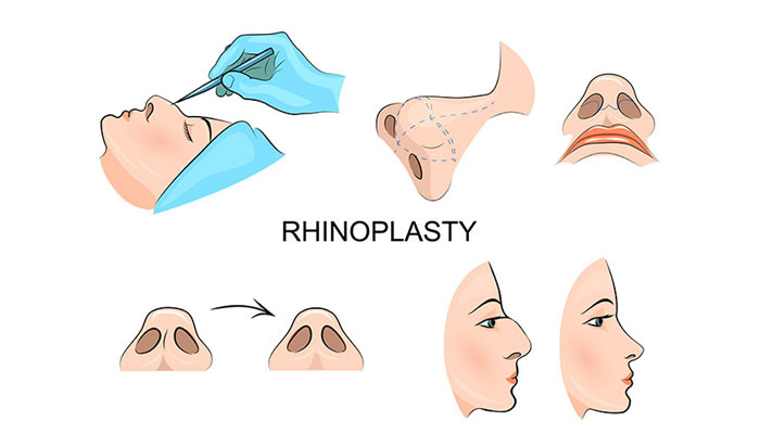 عمل بینی با تامپون بهتر است یا بدون تامپون؟ 1 عمل-بینی-با-تامپون-بهتر-است-یا-بدون-تامپون؟