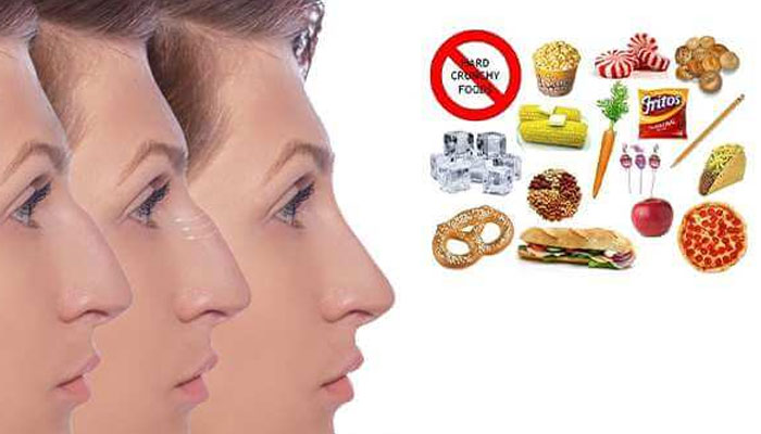 قبل از عمل بینی چی بخوریم؟ 4 مواد-غذایی-ممنوع-پیش-از-عمل-بینی