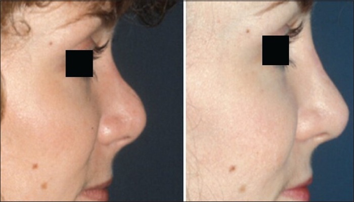 سوهان کشی بینی بعد از عمل 2 انجام سوهان کشی بینی