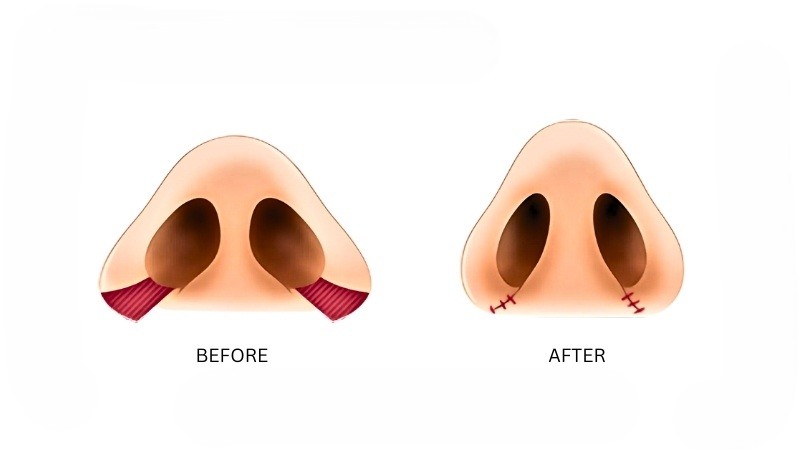 هزینه عمل بینی گوشتی 21 آلاربِیز رداکشن