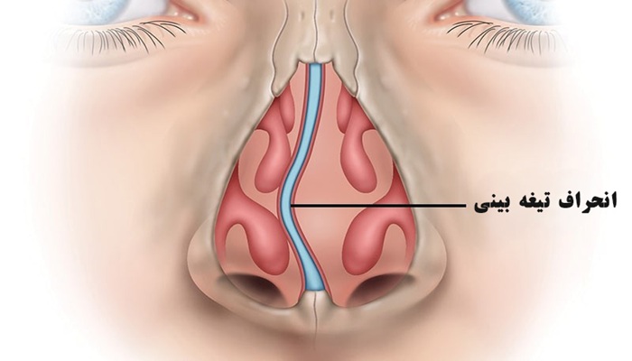هزینه و شرایط عمل بینی با بیمه 4 انجراف تیغه بینی