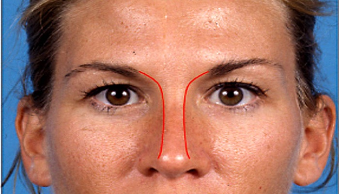 خط کانتور در عمل بینی چیست 4 ایجاد خط کانتور در عمل بینی