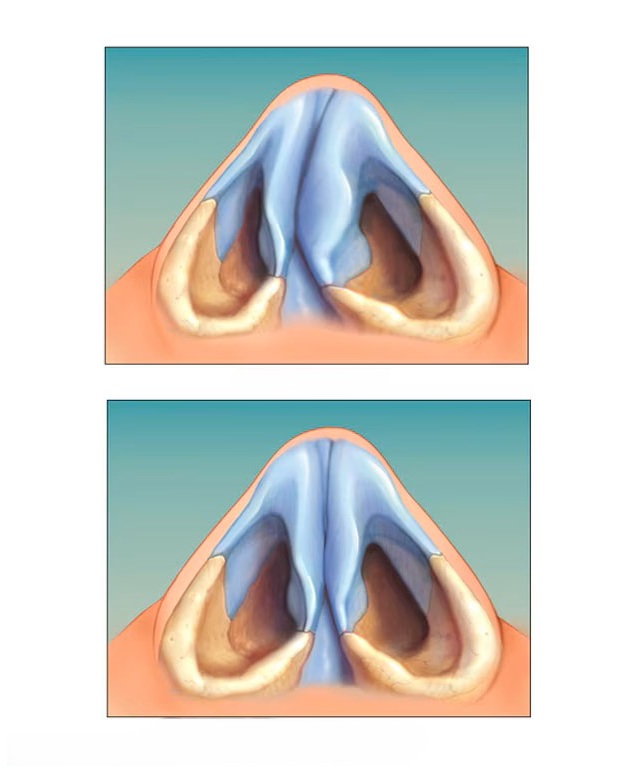 هزینه و شرایط عمل بینی با بیمه 5 تیغه بینی سالم و منحرف