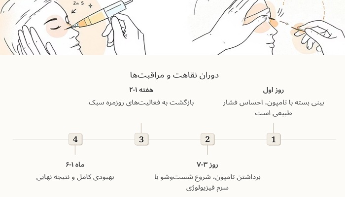 دوران نقاهت بعد از عمل بینی