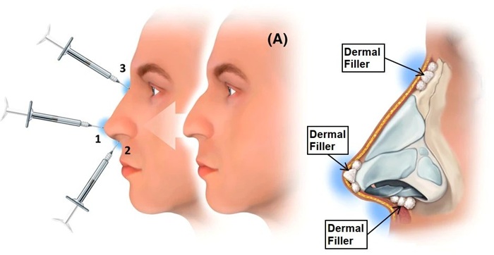 لیفت بینی با نخ بهتر است یا فیلر؟ 3 لیفت بینی با فیلر