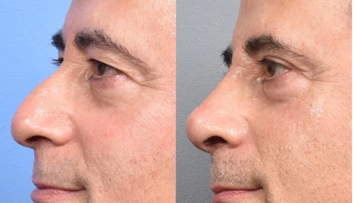 کوچک شدن بینی بدون عمل جراحی 2 کوچک شدن بینی با فیلر