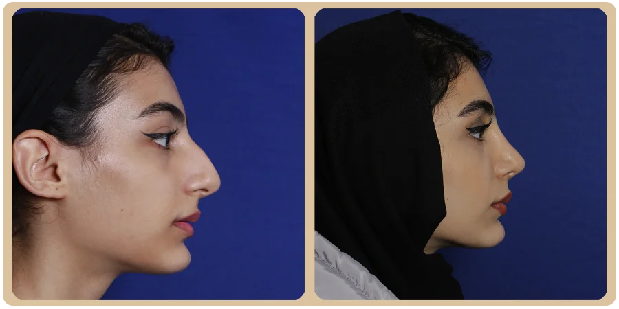 هزینه عمل بینی مردانه 12 13ba