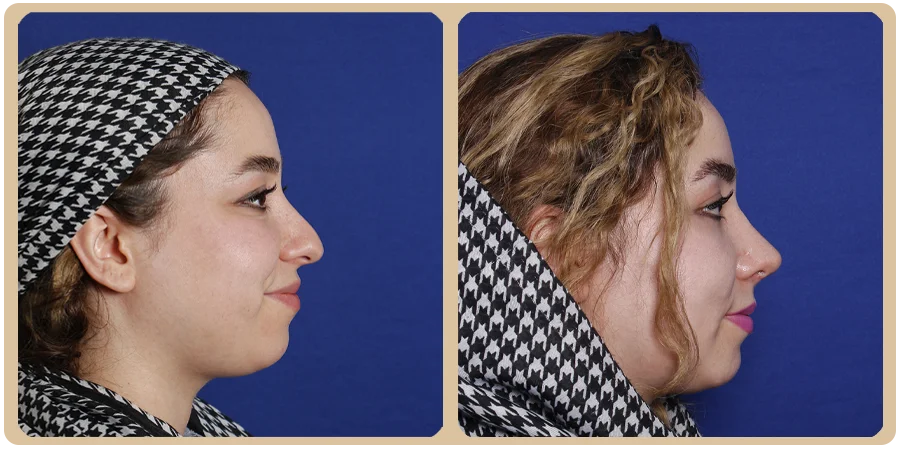 هزینه عمل بینی مردانه 13 14ba