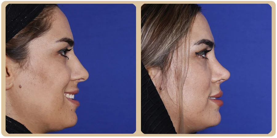 هزینه عمل بینی مردانه 14 15ba