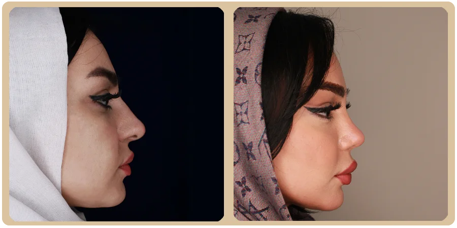 هزینه عمل ترمیمی بینی 12 21ba