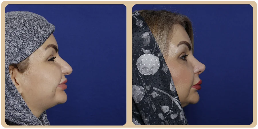 هزینه عمل ترمیمی بینی 13 22ba