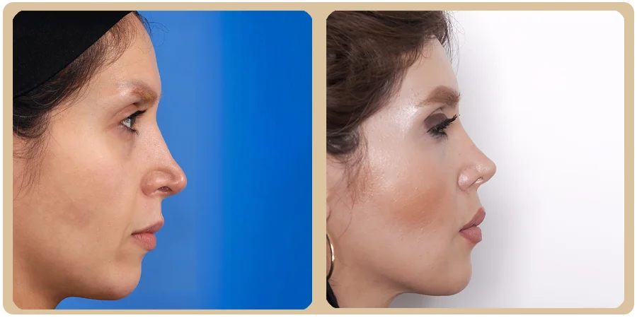 هزینه عمل ترمیمی بینی 14 23ba