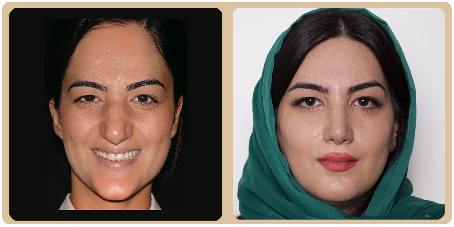 هزینه عمل ترمیمی بینی 15 24ba