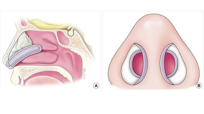 چند روز بعد از عمل بینی اسپلینت برداشته میشود؟ 4 اسپلینت داخلی