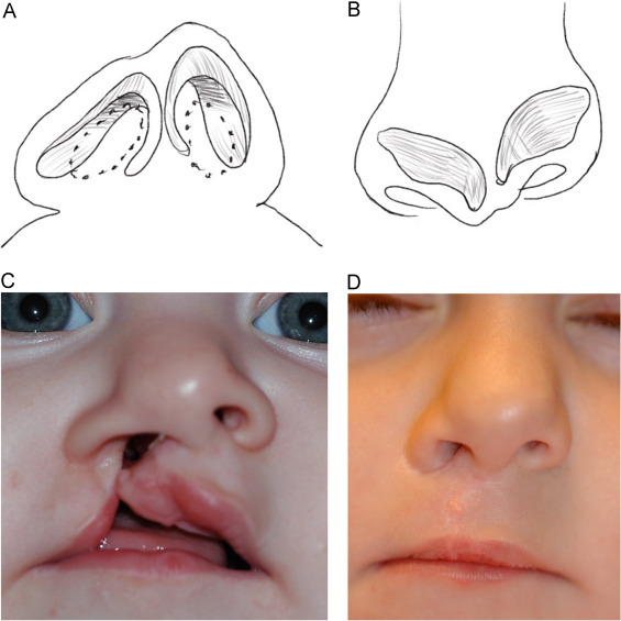 عمل بینی افراد لب شکری 1 تصویر بیمار لب شکری