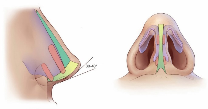 گرافت کلوملا
