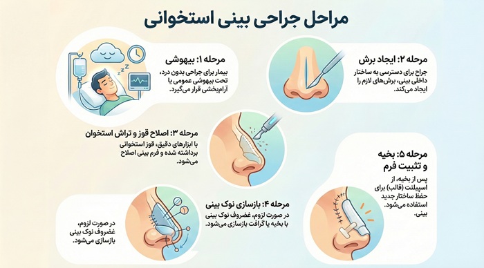 هزینه عمل بینی استخوانی 28 مراحل عمل بینی استخوانی